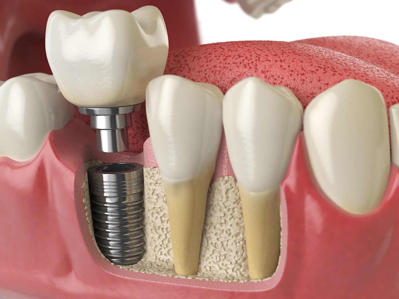 Dental Implants Intro